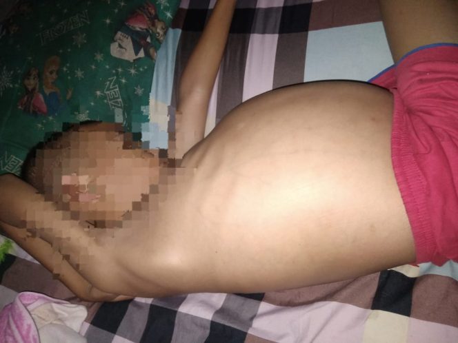 
					Miris, Kisah Zaki Penderita Hirschsprung Disease di Pangandaran Kerap Dibully